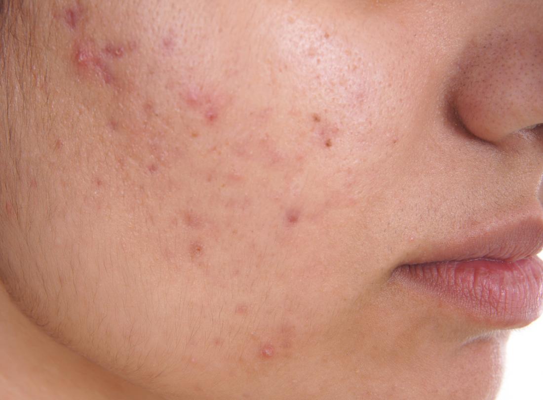 Acne: Causes, treatment, and tips