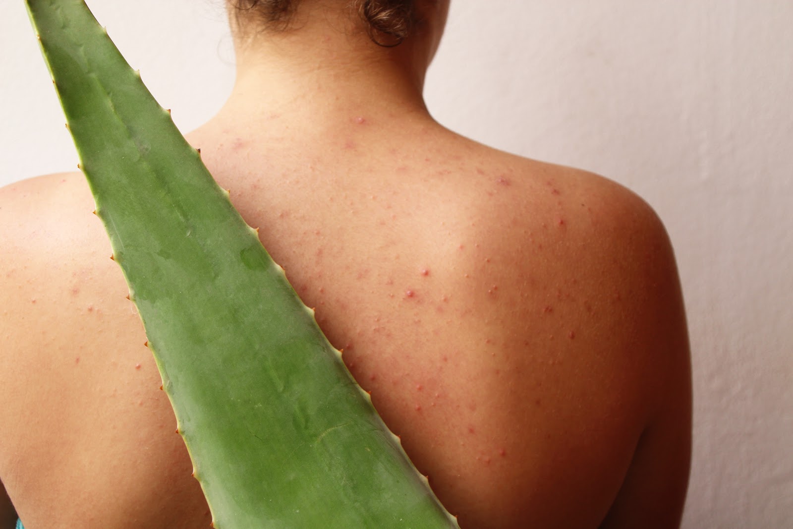Aloe vera for Acne
