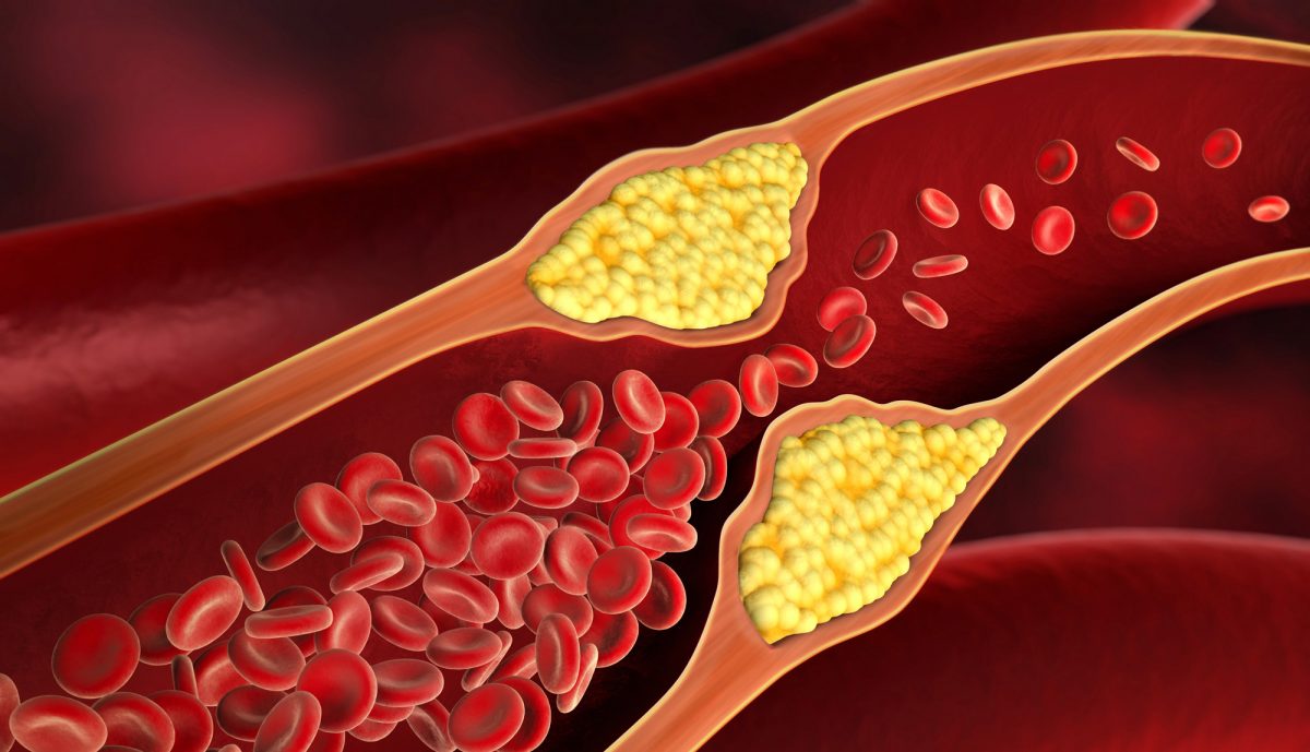 Leqvio: Newest Drug Against 'Very Bad' Cholesterol | BioPharma Media