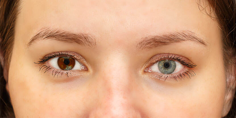 Why Are My Eyes Changing Color? - American Academy of Ophthalmology