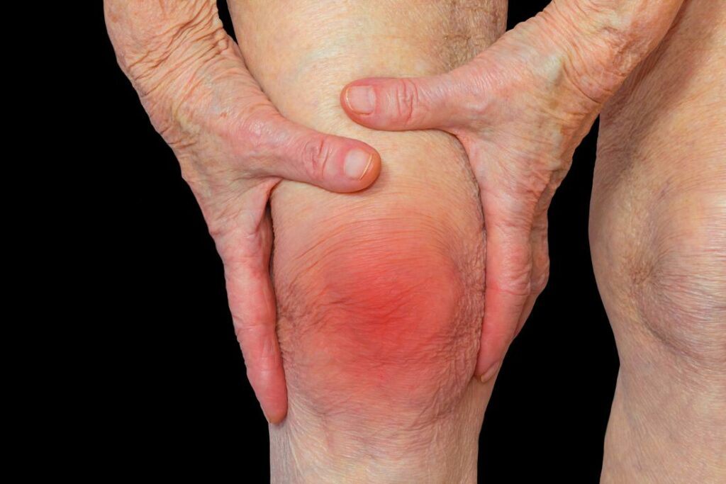 rheumatoid-arthritis-knee.