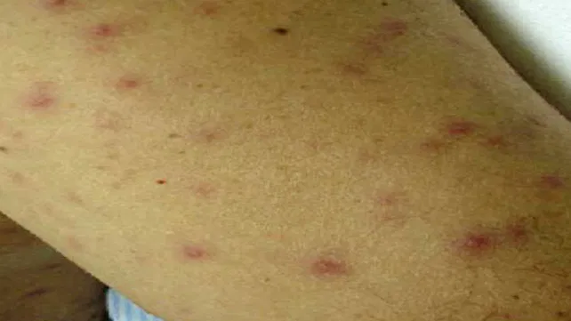 Typhus-Worst Dangerous Diseases in the History