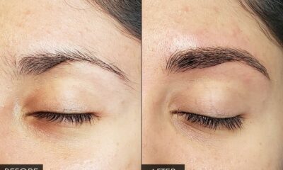 eyebrow hair transplant near me