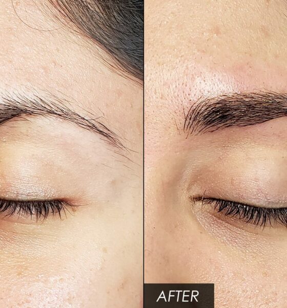 eyebrow hair transplant near me