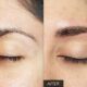 eyebrow hair transplant near me